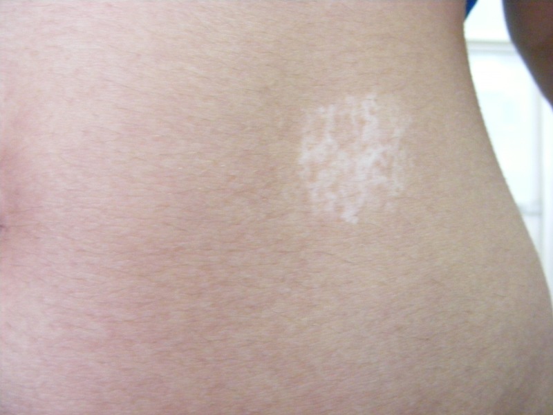 vitiligo, repigmentare partiala dupa tratament